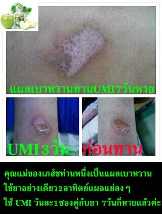 เบาหวาน-เอเจล-hba1c-จอยริน-จอย-เอเจล-agel-ราคาสมาชิก-ราคาถูก-เบาหวาน-มะเร็ง-ไตเสื่อม-umi-exo-hrt-min-grn-เอเจล-สมัครธุรกิจ