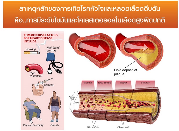 hrt-agel-LDL-agel-hrt-เอเจล-อาเจล-จอย-gel-geltreat-ราคาถูก-ราคาสมาชิก-ฮาร์ท-heart-ไขมันสูง-ไม่อยากทานยา-อาหารเสริม-ผ่านอย-หัวใจตีบ-ความดันสูง-บำรุงหัวใจ-บายพาส-บอลลูน-โคเอ็นไซด์คิวเท็น-coq10-ทอรีน-แอลคาร์นิทีน-เห็ดหอยนางรม-รักษา-โรคหัวใจ-ไม่อยากผ่าตัด-เหนื่อยง่าย-ป้องกันโรคหัวใจ-ไขมันเลว-คอเลสเตอรอลสูง-อยากลดคอเลสเตอรอล-ไม่ทานยา
