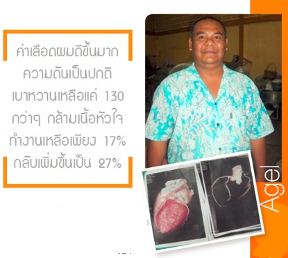 heart-agel-agel-hrt-เอเจล-อาเจล-จอย-gel-geltreat-ราคาถูก-ราคาสมาชิก-ฮาร์ท-heart-ไขมันสูง-ไม่อยากทานยา-อาหารเสริม-ผ่านอย-หัวใจตีบ-ความดันสูง-บำรุงหัวใจ-บายพาส-บอลลูน-โคเอ็นไซด์คิวเท็น-coq10-ทอรีน-แอลคาร์นิทีน-เห็ดหอยนางรม-รักษา-โรคหัวใจ-ไม่อยากผ่าตัด-เหนื่อยง่าย-ป้องกันโรคหัวใจ-ไขมันเลว-คอเลสเตอรอลสูง-อยากลดคอเลสเตอรอล-ไม่ทานยา