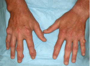 tophi_hand-300x220