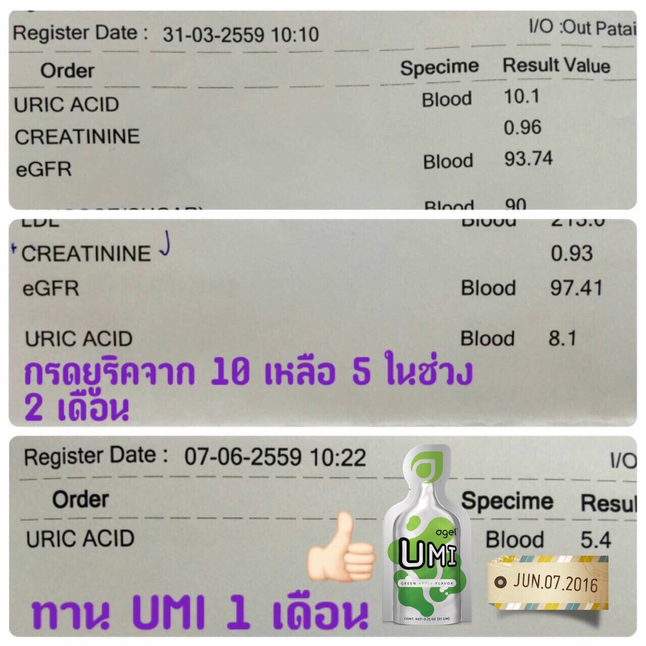 เก๊าท์-เก๊าต์-โรคเก๊าท์-ปวดข้อ-อาหารเสริม-ยารักษา-อาการ-umi-grn-agel-ราคาถูก-ราคาสมาชิก-ตัวแทน-สมัครสมาชิก-เก๊าส์-umi-grn-agel-uric-acid-อาเจล-ข้อบวม-ยูริค-ยูริก-เก๊าท์-เก๊า-รักษา-ยังไง-หายไหม-อูมิ-อะไรดี-อาหารเสริม